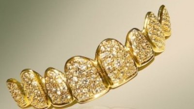 В Дубае стоматологи изготовили золотые накладки на зубы